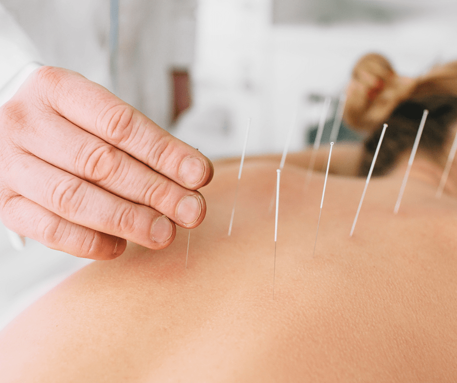 Acupuncture In Wandsworth