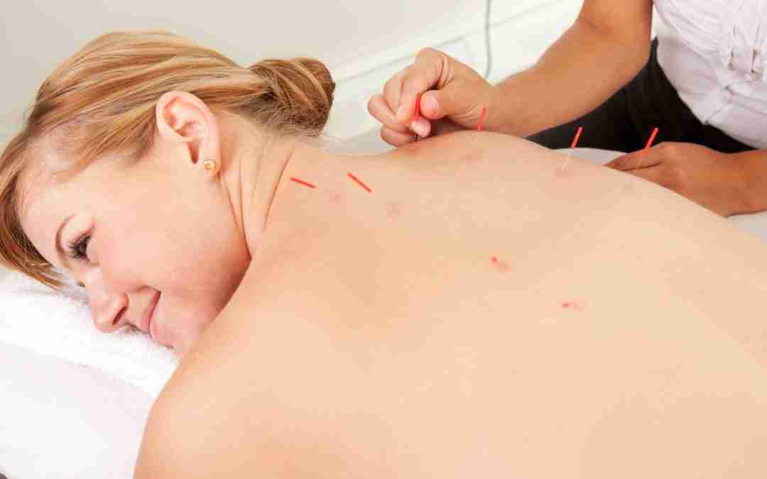 Western medical acupuncture and dry needling for myofascial pain