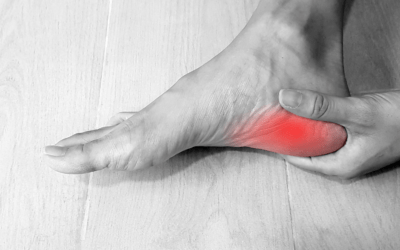 UPDATED: Running injuries of the foot – plantar fasciitis