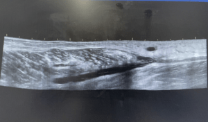A significant medial gastrocnemius strain