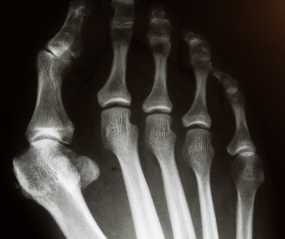 Forefoot pain