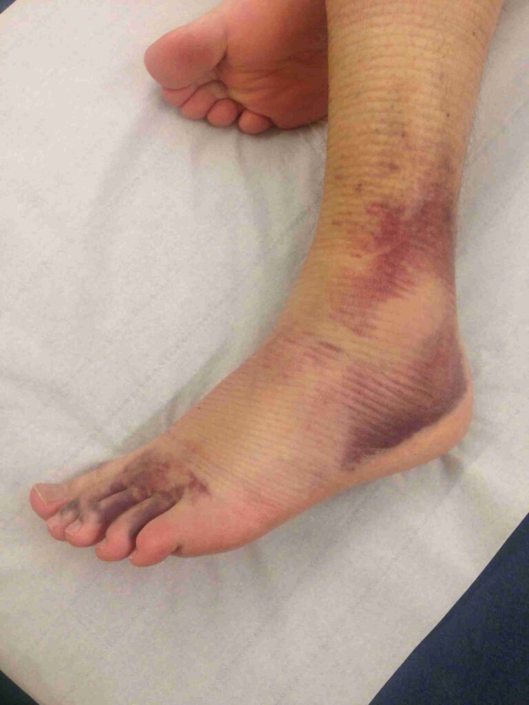 Ankle injuries 2 IMG 8383 scaled 1