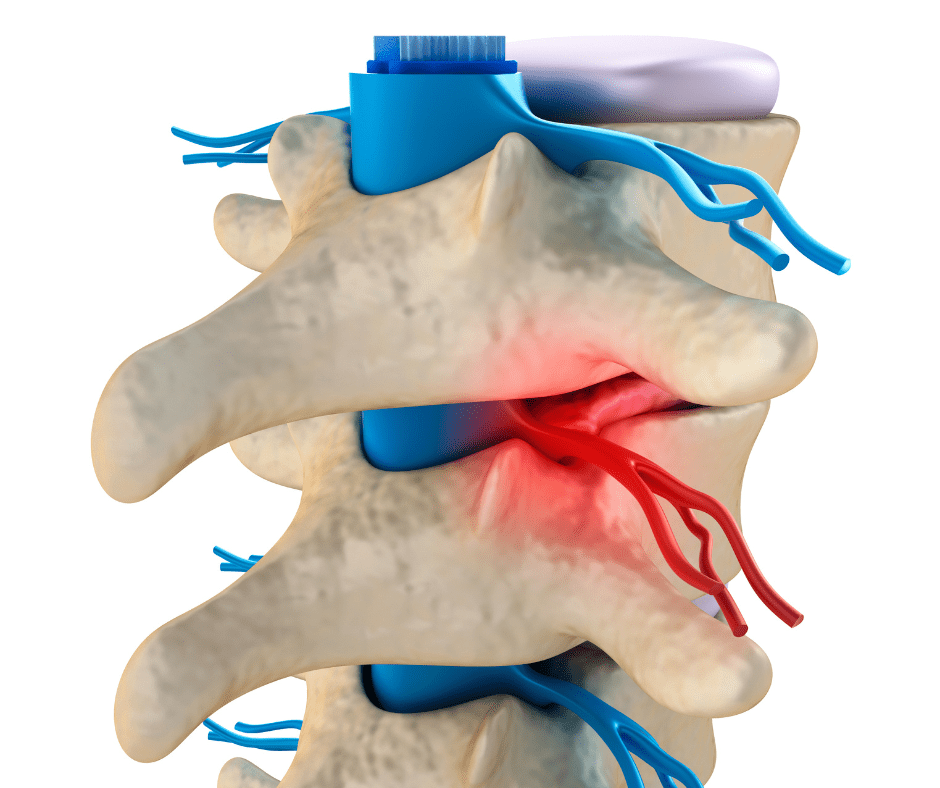 My Back Pain Story 1 Treatment for a disc bulge