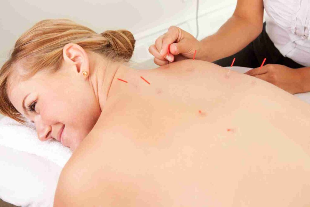 Western medical acupuncture and dry needling for myofascial pain 3 acuphoto