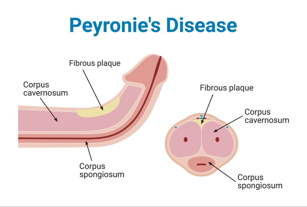Treatment for Peyronie's disease