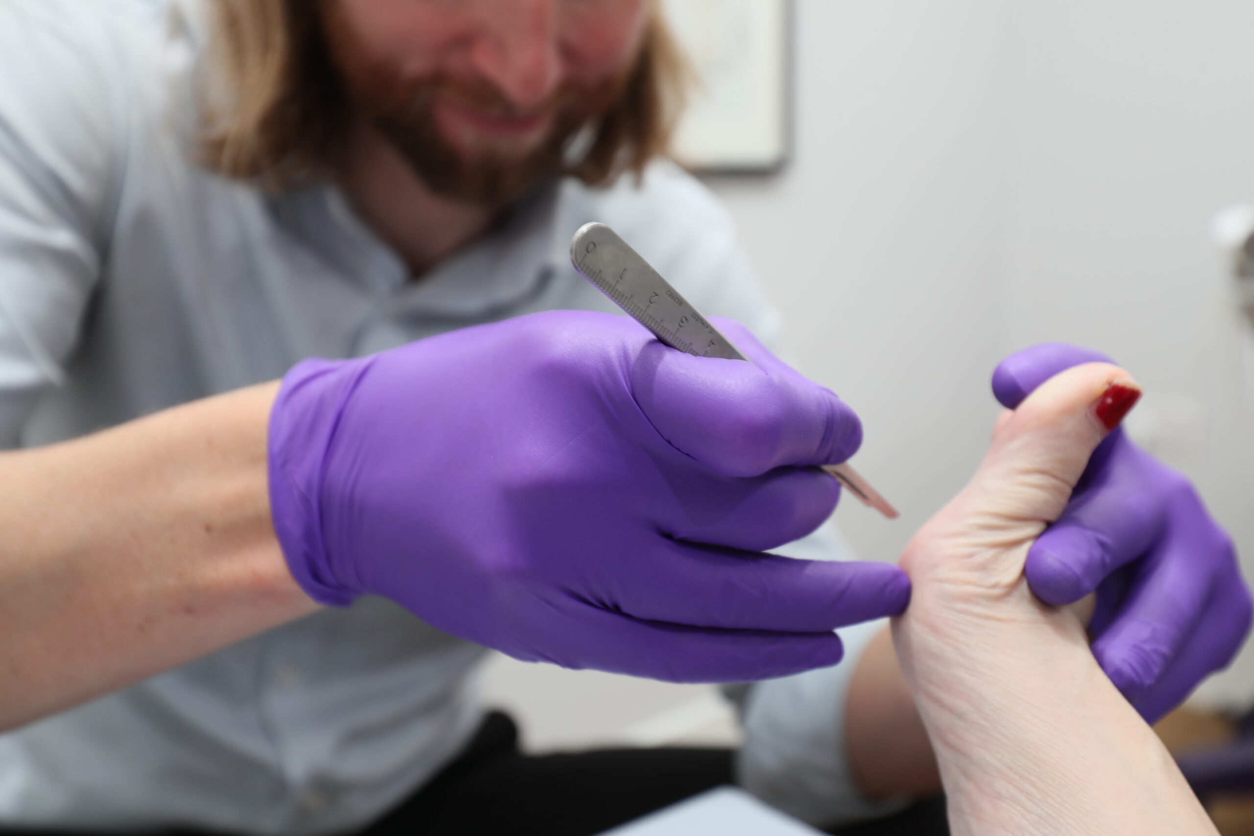 Verruca treatment and verruca needling
